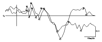 グラフ1　NS3の画像刺激（Czは記録電極の中心領）